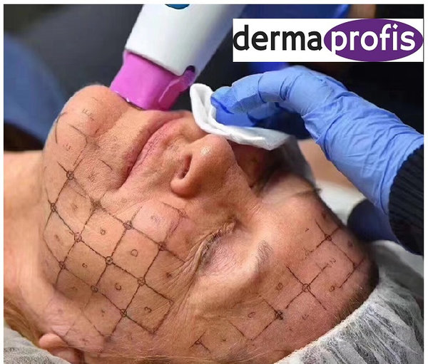 Fractional Thermo Gerät mit Trolly Radiofrequenz DPD1178